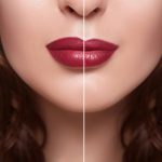 Lip fillers and lip augmentation London