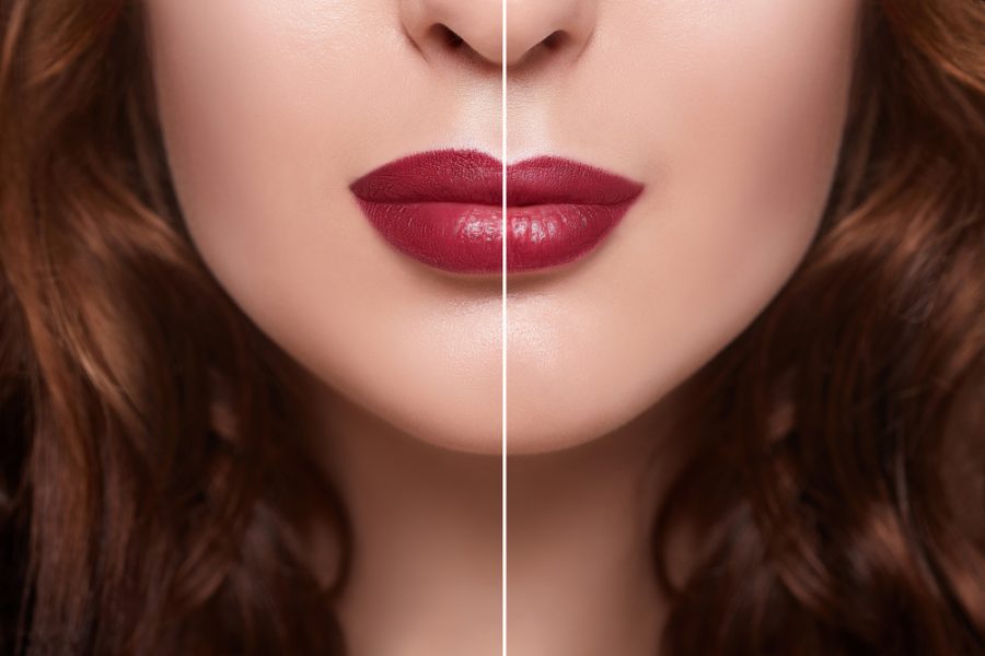 Lip fillers and lip augmentation London